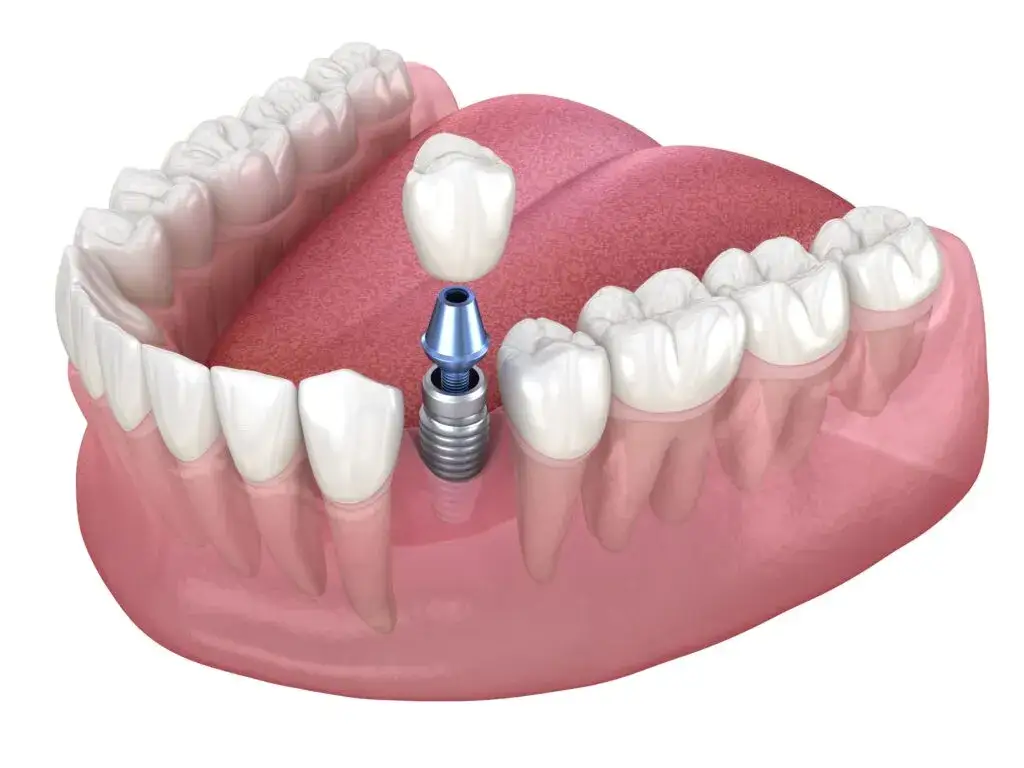 implant zębowy koszt