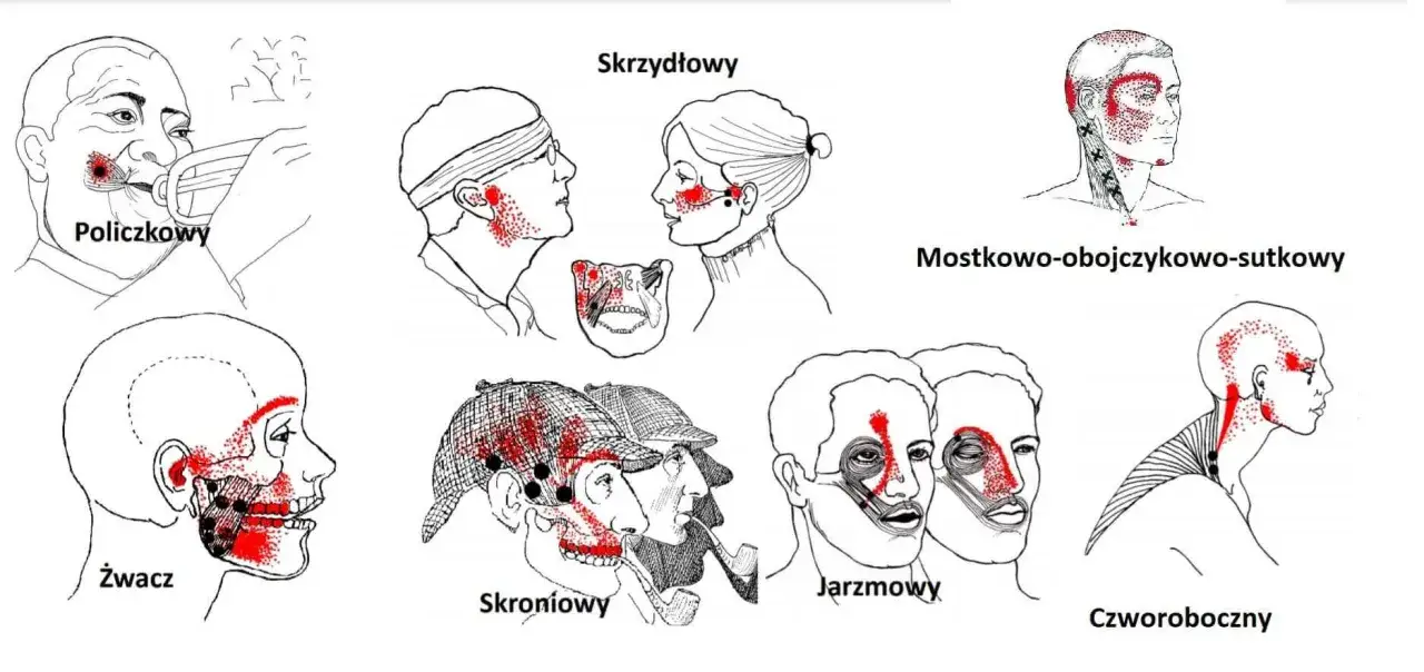 Ilustracje pokazują punkty bólu żuchwy i okolicznych mięśni, wskazując potencjalne źródła dyskomfortu.