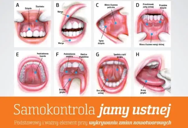 czynniki ryzyka rak jamy ustnej infografika