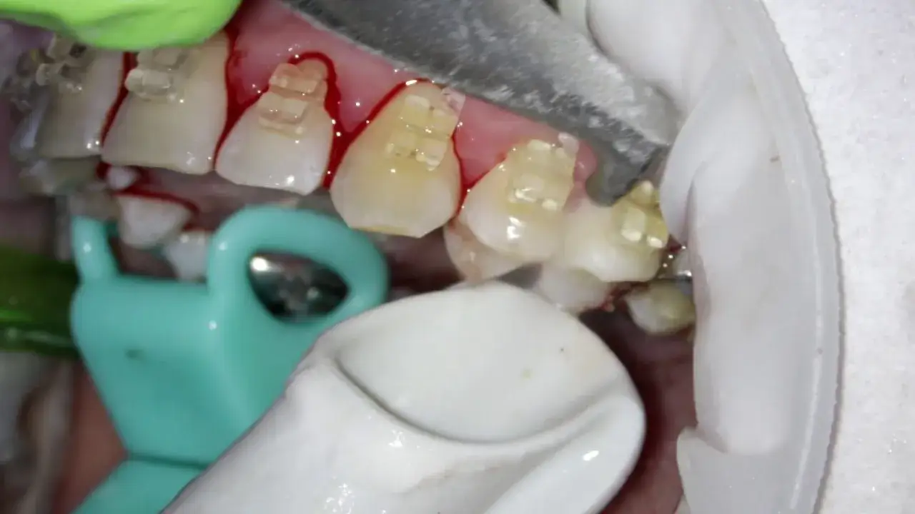 skaling piaskowanie zębów dentysta