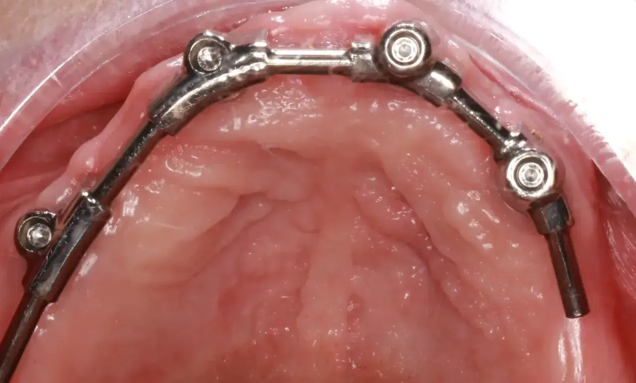 Metalowa belka stabilizująca implanty w jamie ustnej, przygotowana pod protezę overdenture.
