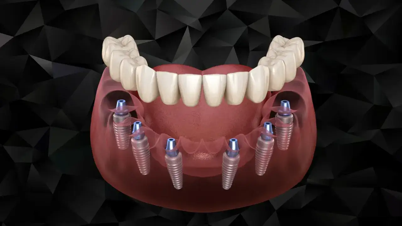 Górna szczęka z sześcioma implantami stomatologicznymi, gotowa do osadzenia protezy all on 6.