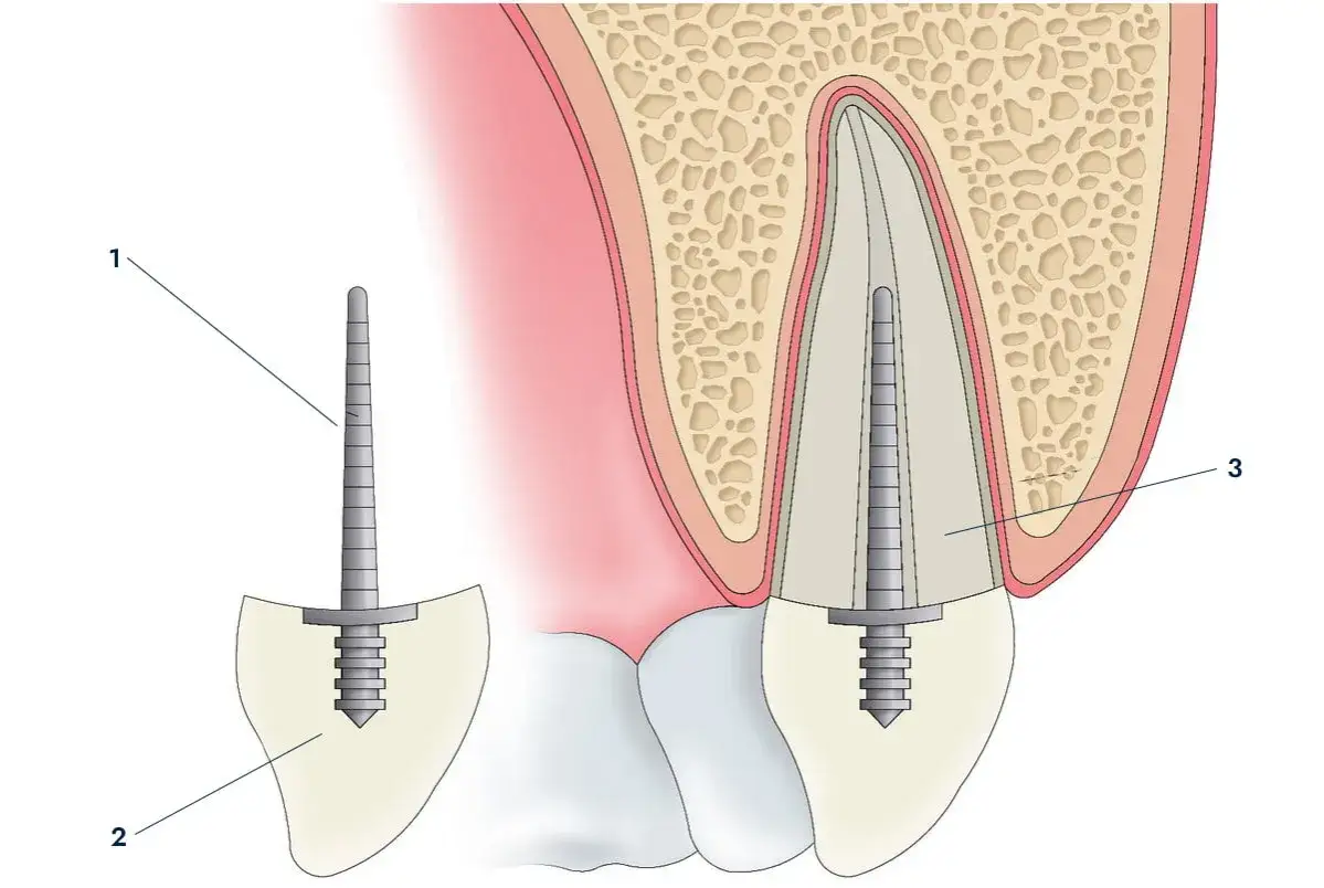 Odbudowa zęba na korzeniu: implant (1) wkręcony w kość, przygotowany do osadzenia korony (2). Widok przekroju zęba z implantem (3).
