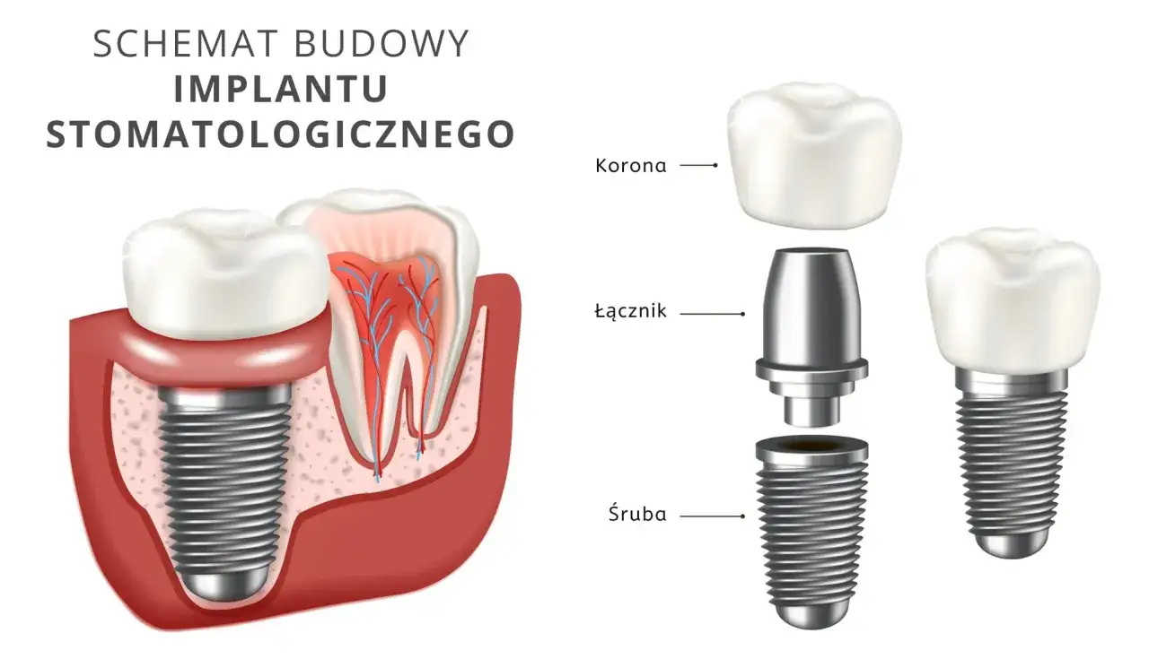 Schemat budowy implantu stomatologicznego: śruba, łącznik i korona. Poznaj elementy wpływające na koszt implantu zęba.