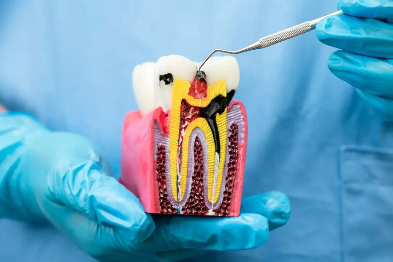 Model zęba z próchnicą. Dentysta w rękawiczkach pokazuje, jak wygląda leczenie kanałowe w ciąży.