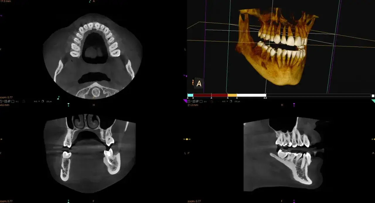 Tomografia komputerowa zębów. Czy tomografia jest szkodliwa? Badanie pokazuje przekroje i obraz 3D szczęki i żuchwy.