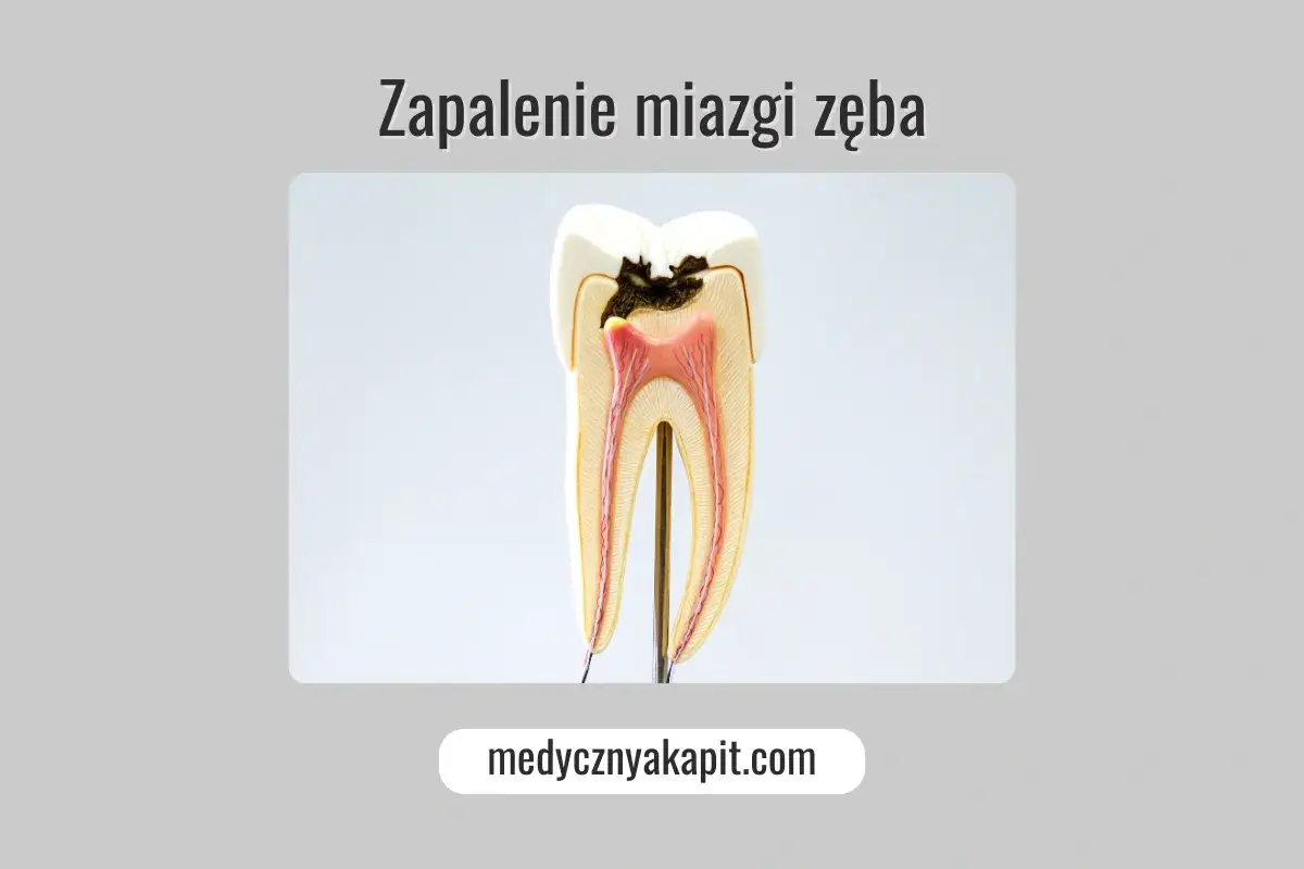 Model zęba z próchnicą i widoczną miazgą. Zapalenie miazgi zęba jak uśmierzyć ból.