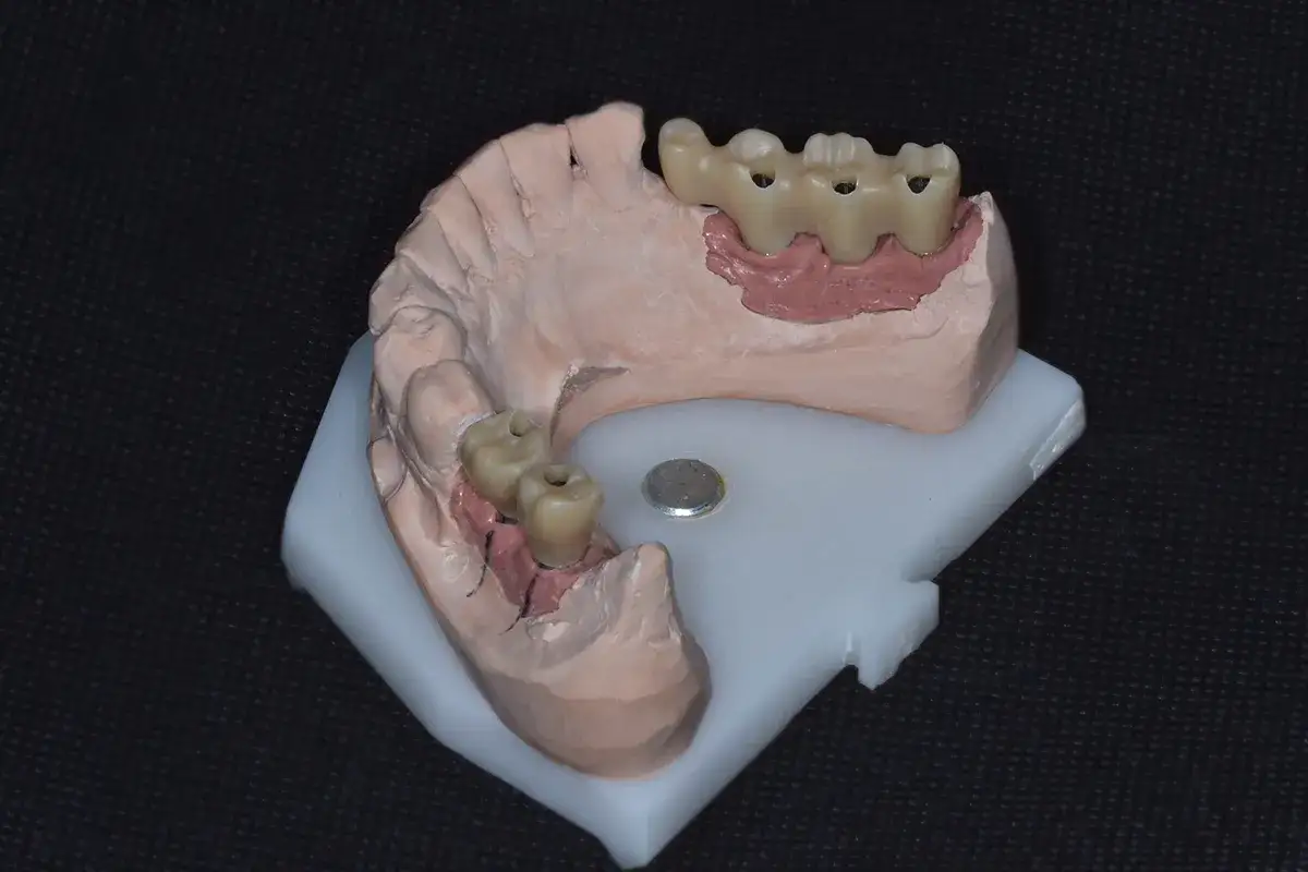 Model szczęki z protezą, która pozwala na swobodne jedzenie i picie.