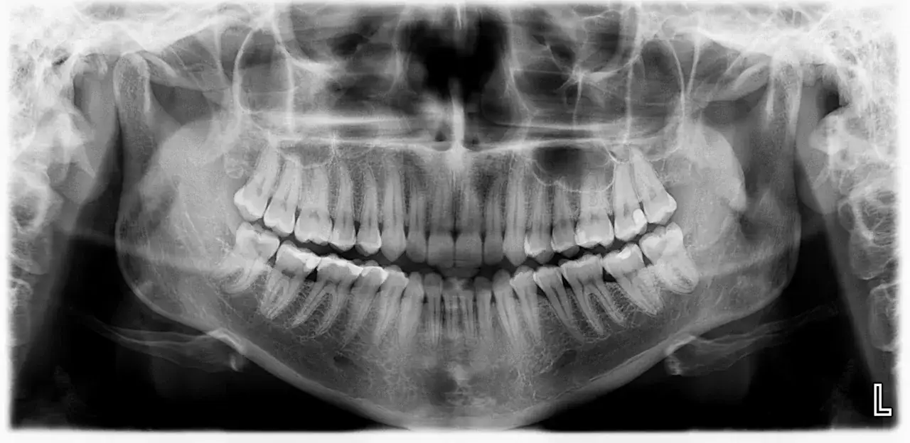 Pantomogram zębów, pokazujący całe uzębienie i szczęki. Zastanawiasz się, ile kosztuje pantomogram?