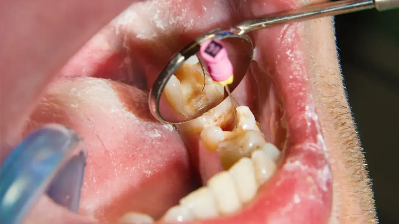 Zabieg endodoncji co to? Widać narzędzie dentystyczne w zębie, co jest częścią leczenia kanałowego.