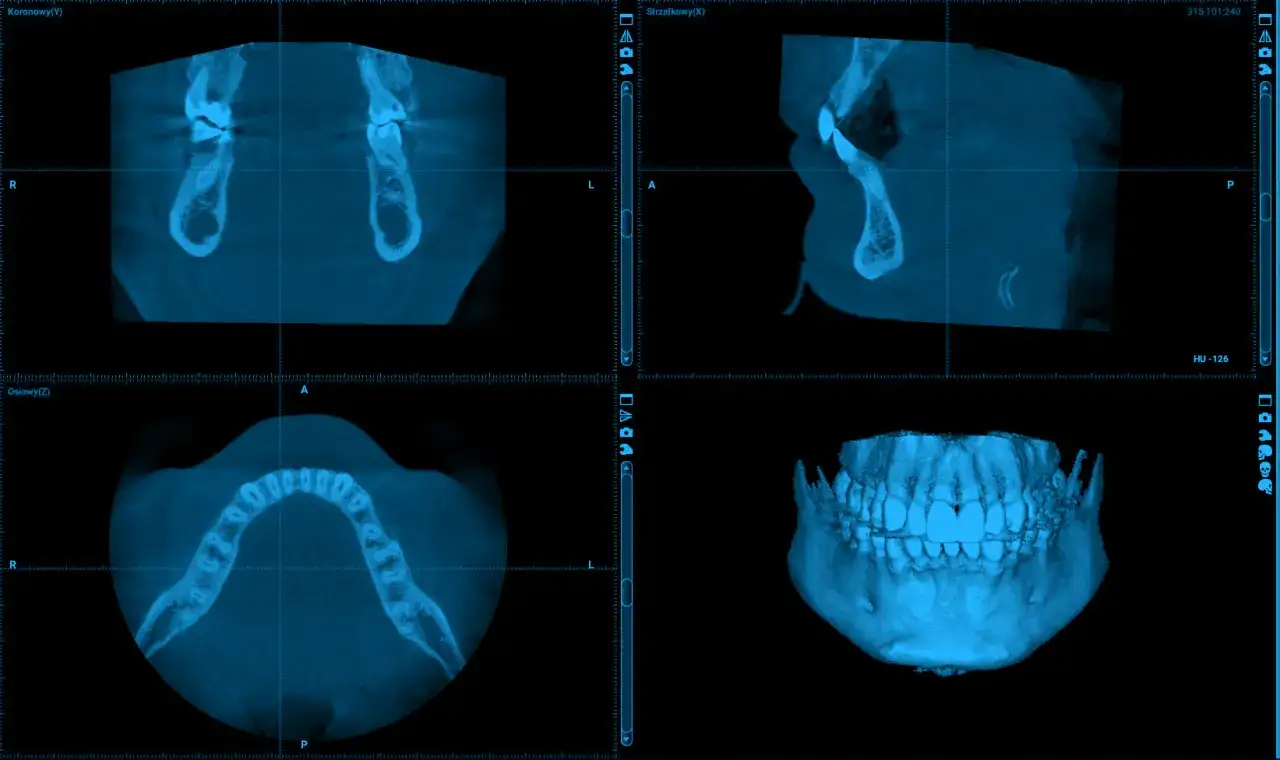 Badanie cbct szczęki i żuchwy w trzech projekcjach: osiowej, strzałkowej i wieńcowej, z wizualizacją 3D.