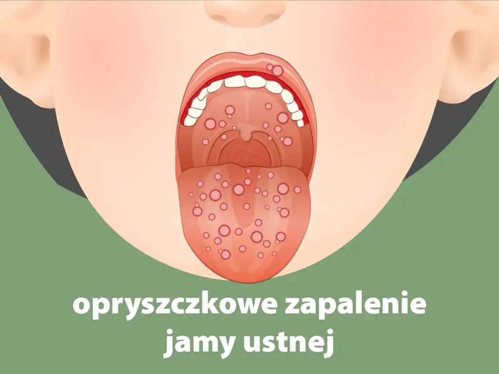 zapalenie jamy ustnej u dziecka rodzaje zmian