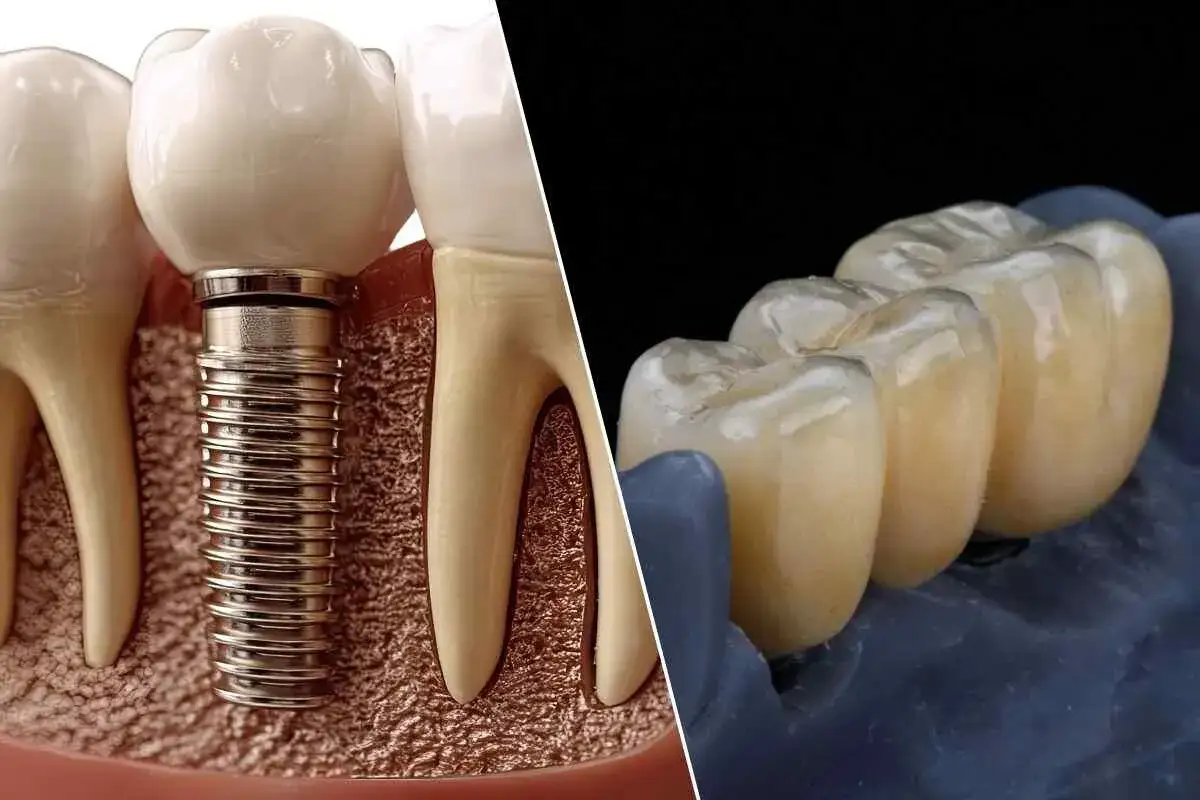 Implant dentystyczny i proteza szkieletowa na zatrzaskach.