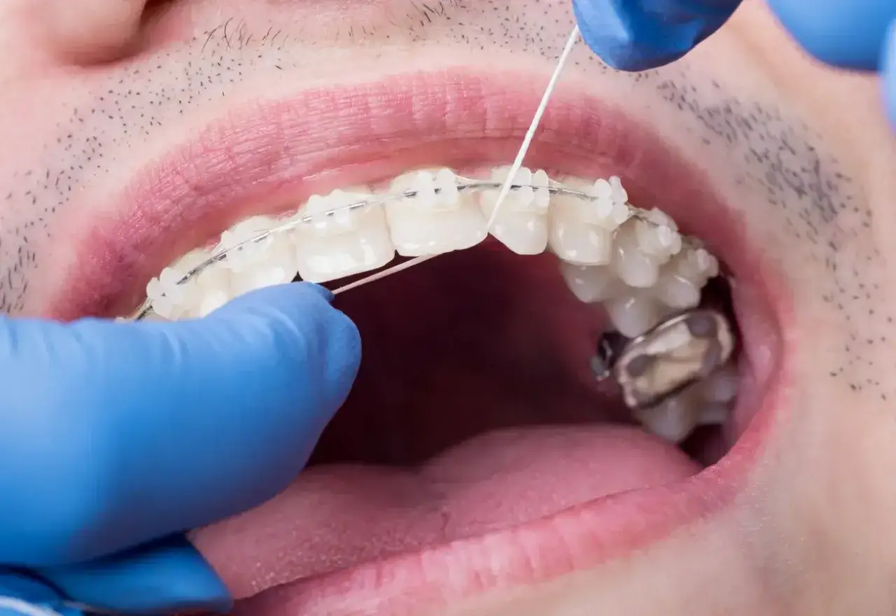Rękawiczki ochronne, nić dentystyczna i aparat ortodontyczny. Technik dentystyczny dba o higienę jamy ustnej.