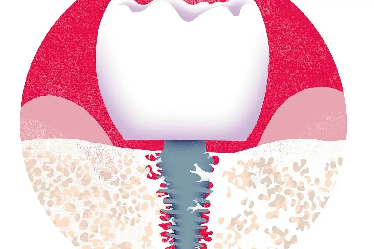 Ilustracja pokazuje implant zębowy z zapaleniem, które może prowadzić do anginy Ludwiga. Czerwone obszary wokół implantu symbolizują stan zapalny.